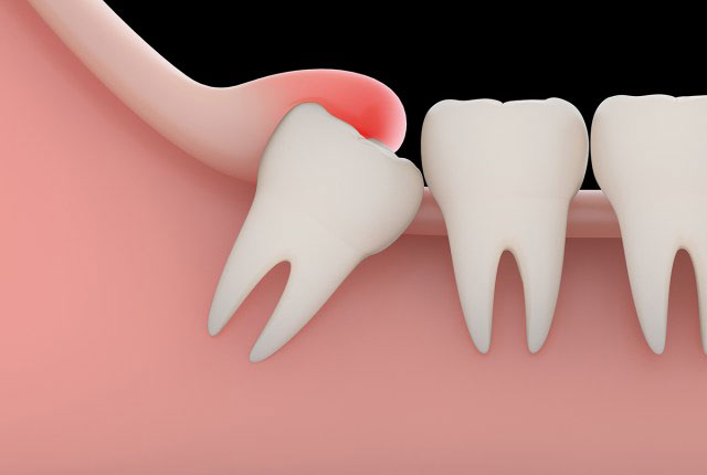 抜歯 痛み 親知らず 抜歯後の痛みを和らげる10の方法